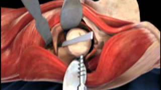 Femoral Head Osteotomy Animation  Direct Anterior Total Hip Replacement [upl. by Cad]