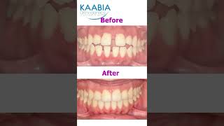 Bimaxillary protrusion  open bite and diastema [upl. by Kinsley]