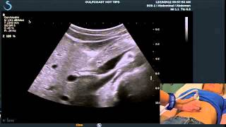 Hot Tips  Locating the Common Bile Duct with Ultrasound [upl. by Eibmab323]