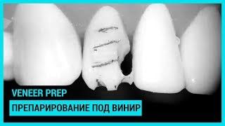 Veneer prep Препарирование под винир [upl. by Levon288]