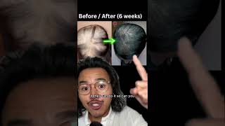 Hair loss IS reversible dermaroller hair dermarollertreatment [upl. by Nylcoj]