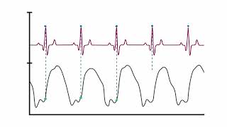 How the LV Waveform is Derived and LVEDP Calculated [upl. by Fokos347]