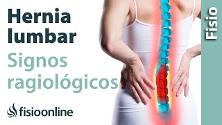 Hernia discal lumbar y protrusión discal  Signos radiológicos [upl. by Yahsan407]