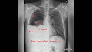 Chest X rays Part 2  Pleural effusion Hydropneumothorax Pneumothorax [upl. by Taryn]