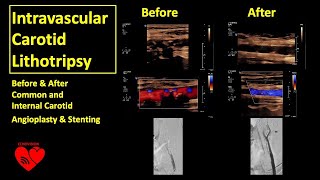 ShockWave Intravascular Carotid Lithotripsy Highly Calcified Carotid Stenosis [upl. by Ainod]