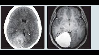 Aicardi syndrome brain imaging radiology cases [upl. by Ynohtnaleahcim]