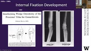 Osteotomy Past Present and Future [upl. by Amena]