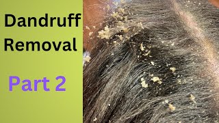 Dandruff Removal Part 2  Huge Flakes [upl. by Lehsreh]