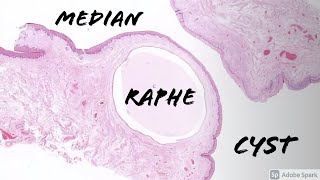 Median Raphe Cyst 5Minute Pathology Pearls [upl. by Nedla]