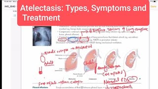 Atelectasis Types Symptoms and Treatment Respiratory 51  First Aid USMLE Step 1 in UrduHindi [upl. by Kirbie]