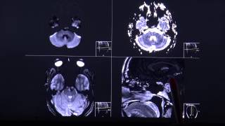 Chordoma  aggressively growing tumor in CT and MRI sequence english [upl. by Yerffe480]