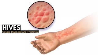 HIVES Causes Signs and Symptoms Diagnosis and Treatment [upl. by Ximenes334]