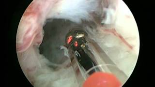 GreenLight Enucleation of the Prostate GreenLEP by Dr Fernando Gomez Sancha [upl. by Kelci]