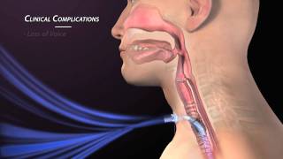 Clinical Complications of Tracheostomy [upl. by Noyes]