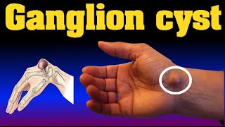 ganglion cyst [upl. by Leciram99]