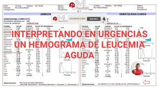 LEUCEMIA AGUDA CLAVES EN LA INTERPRETACIÓN DEL HEMOGRAMA [upl. by Bertram474]