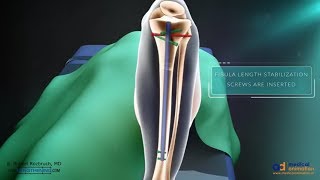 Precice Tibia Lengthening Surgical Animation [upl. by Jelle793]