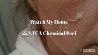 Home Tca Peel 25 Skin Obsession [upl. by Nolyarg]