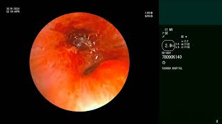 Airway Foreign Body  Whistle  Bronchoscopic retrievel [upl. by Pogah]