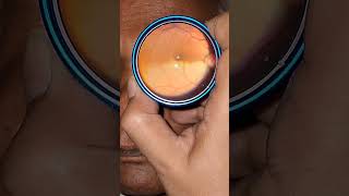 Branch Retinal Artery Occlusion retina eyehospital shantanunetralaya eyedoctor [upl. by Alyhs]