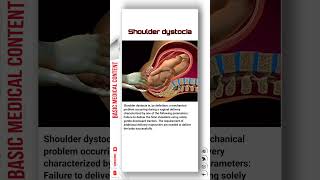 Shoulder Dystocia shoulder shoulderdystocia pregnancy [upl. by Krum]