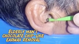 Elderly Mans Chocolate Chiplike Earwax Removal [upl. by Ahsienaj]