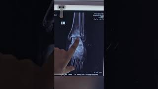 Septic arthritis in ankle joint fusion surgery arthritis shorts [upl. by Canute]