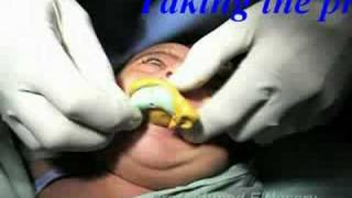 Feeding Obturatore for Asseer 4 month baby with Cleft Palate Clinical Pediatric Dentistry [upl. by Denis]