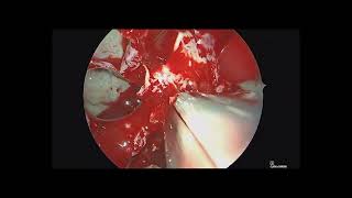 Transmaxillary and Endoscopic Transpterygoid Approach for V2 Resection for Perineural Tumor Spread [upl. by Enomrej]