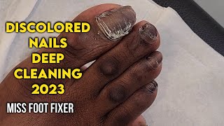 CLEANING TOENAIL 🦶🏽 DISCOLORED TOENAILS DEEP CLEANING BY FAMOUS PODIATRIST MISS FOOT FIXER [upl. by Friedberg664]