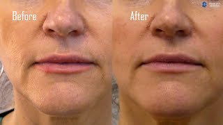 Collagen and PRP injections Before and After  Eskulap Beauty News [upl. by Akeret]