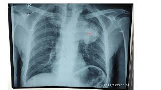 Bronchogenic Carcinoma [upl. by Mcloughlin355]