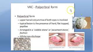 Ophthalmology 088 b Vernal KeratoPathy VKC Shield ulceration Cornea Eye PseudoGeronToxon Types [upl. by Petrick]