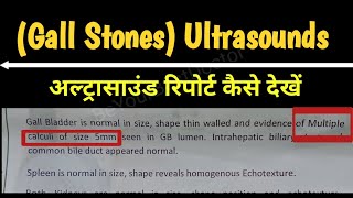 How To Read Ultrasounds ReportGall Stone  पित्त की थैली में पथरी Multiple Gall Stones  USG Hindi [upl. by Isidora]