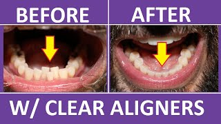 Invisalign Braces Before and After Overbite Crowding Teeth Cost Pain Tips 3M Clear Aligners [upl. by Gillie61]