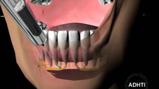 инфильтрационная анестезия на нижней челюстиinfiltration anesthesia in the mandible [upl. by Dulsea]