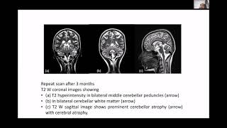 Management of Inhalant Use Disorders by Dr V L Narasimha [upl. by Gildus66]