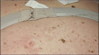 441 Seborrheic Keratosis Removal on Back Janine giving training [upl. by Quick]