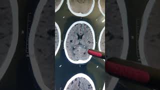 INTRACRANIAL CALCIFICATION doctor hospital  shorts video [upl. by Dwayne]