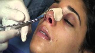 The Kotler Nasal Airway  Removal of the Airway [upl. by Arleen]