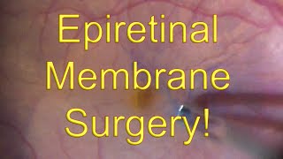 Epiretinal membrane surgery Vitrectomy with ERM Macular Pucker peeling  Dr Simon Chen [upl. by Enialedam17]