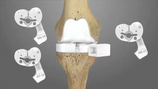 iTotal CR Total Knee Replacement Surgical Technique Animation  Conformis [upl. by Araldo]