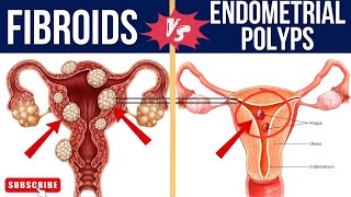 SIMILARITIES AND DIFFERENCES BETWEEN FIBROID AND ENDOMETRIAL POLYPSfibroid endometrium [upl. by Milton113]