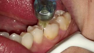 Endodontia de Molar Inferior [upl. by Nosde]