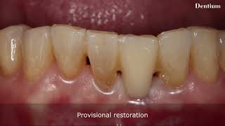 Narrow ridge Implant surgery with bright TL [upl. by Whitman39]