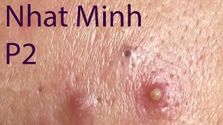 Acne Treatment Huong Da Nang 029  Treatment for Nhat Minh Part 2 [upl. by Lukas]