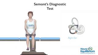 Semont Maneuver A Step by Step Guide to Treat BPPV Vertigo [upl. by Onirefez]