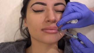 Restylane Defyne Lip Augmentation as a 2nd Syringe [upl. by Ebsen]