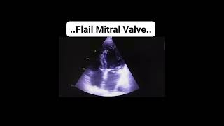 Flail mitral valve echocardiography echoheartmonitoring cardiologyytshortsSafaMedicalLecture [upl. by Herodias179]