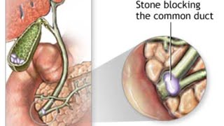 Choledocholithiasis amp Cholangitis [upl. by Yttak]